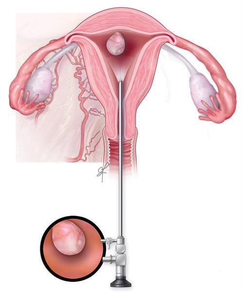 Endometrial polip hakkında bilgi